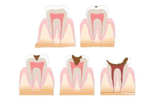 虫歯の進行段階と治療法